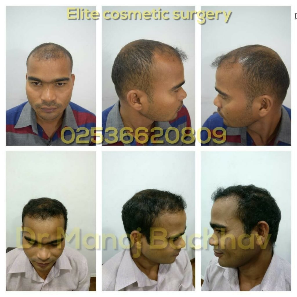 Best Hair Transplant Treatment Cost in Nashik | DHI Hair Transplant in Nashik | Super Fue Hair Transplant in Nashik Best Hair Transplant Treatment Cost in Nashik | DHI Hair Transplant in Nashik | Super Fue Hair Transplant in Nashik