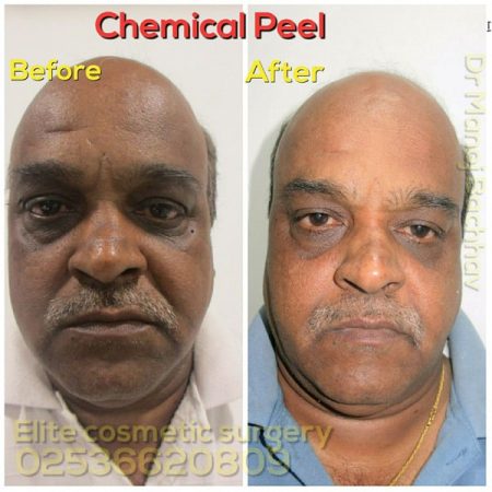 chemical-peel