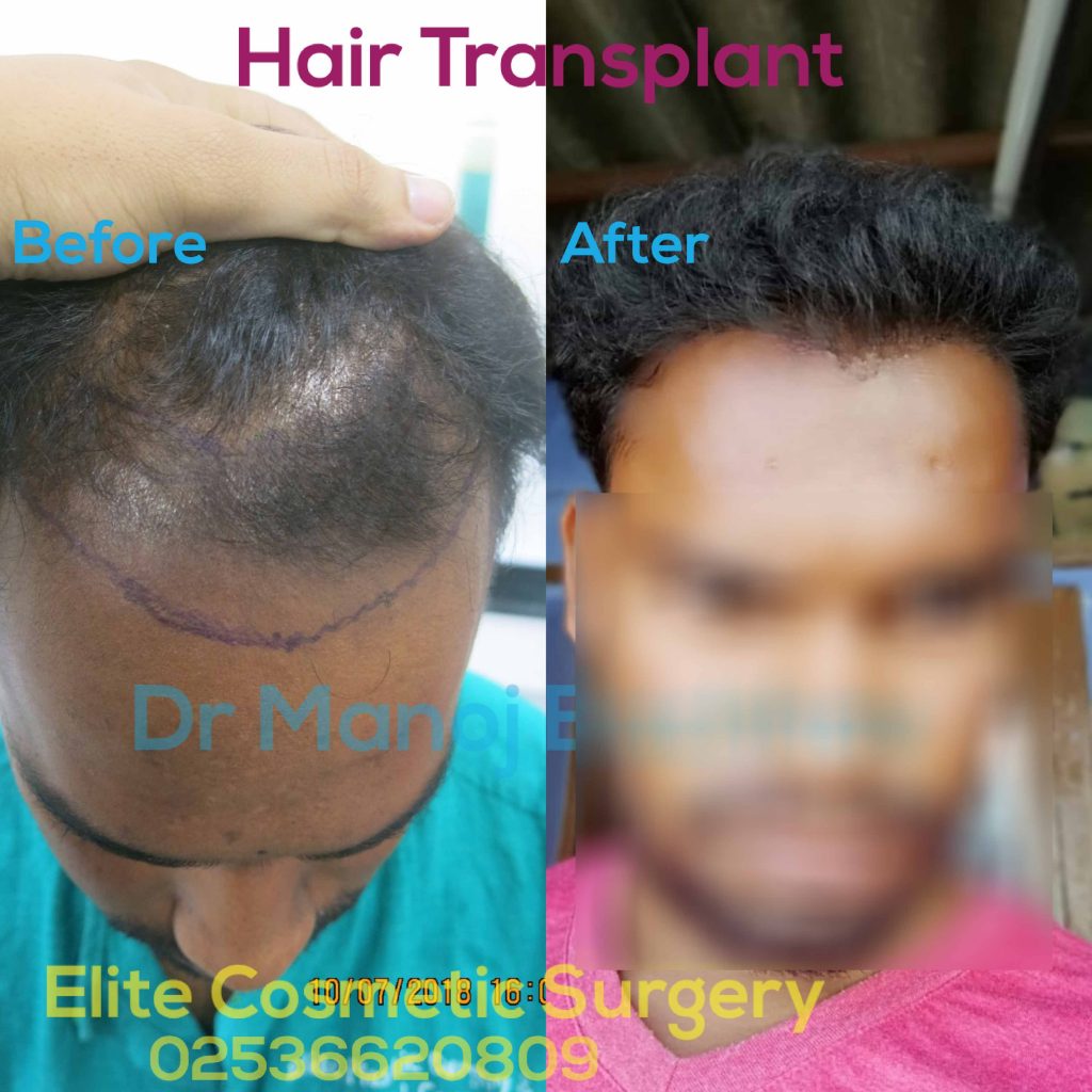 Before & After Part 1 - bachhavcosmeticsurgery Before & After Part 1 - bachhavcosmeticsurgery