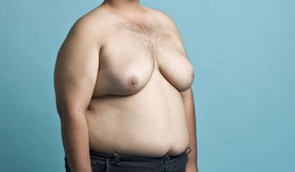 Gynecomastia-Surgery