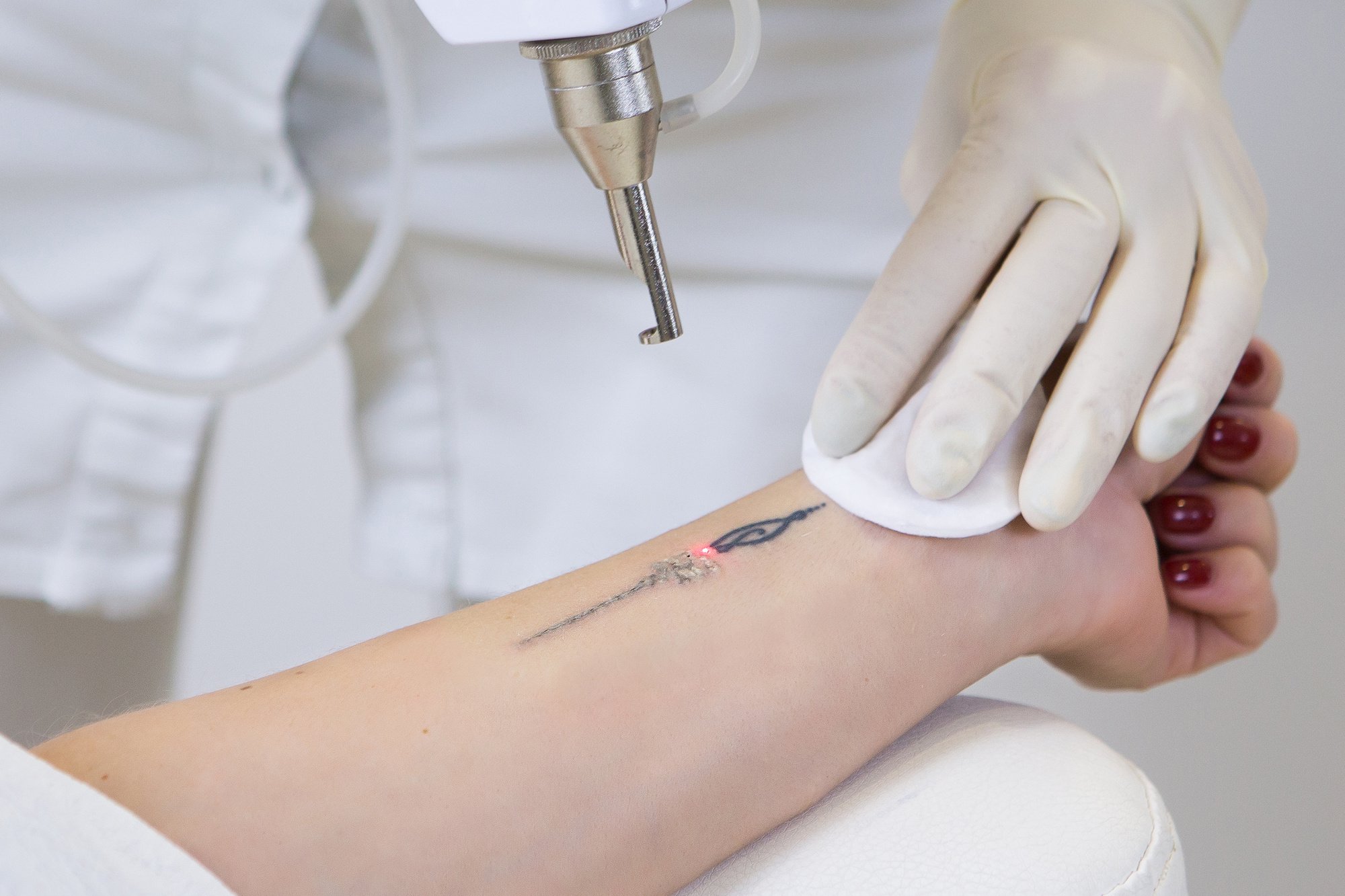 Remove That Mistake in Half the Time with This New Innovation in Tattoo  Removal
