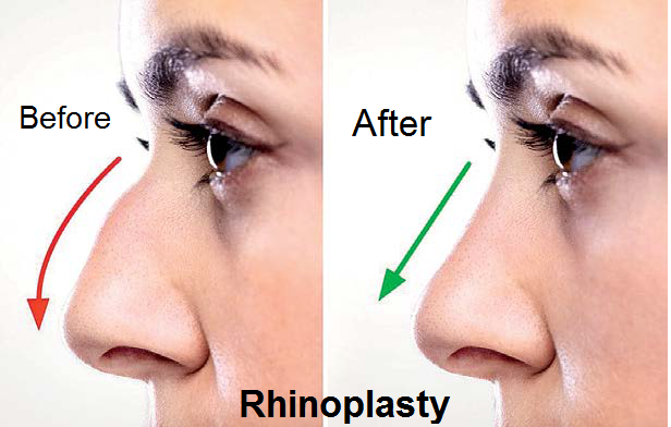 Rhinoplasty