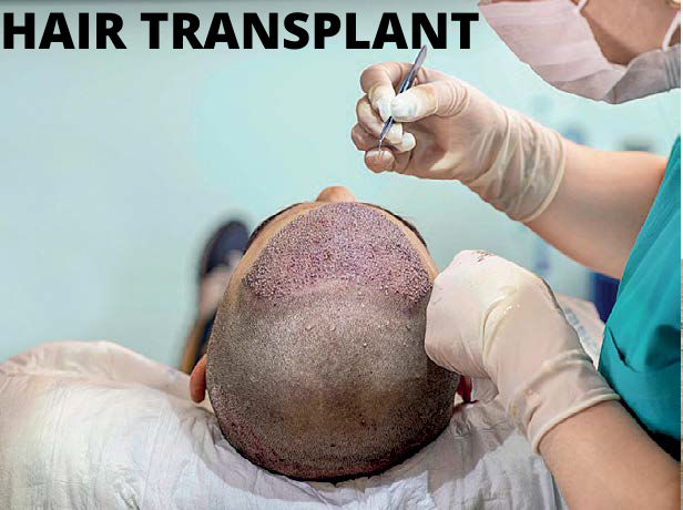 HAIR TRANSPLANT