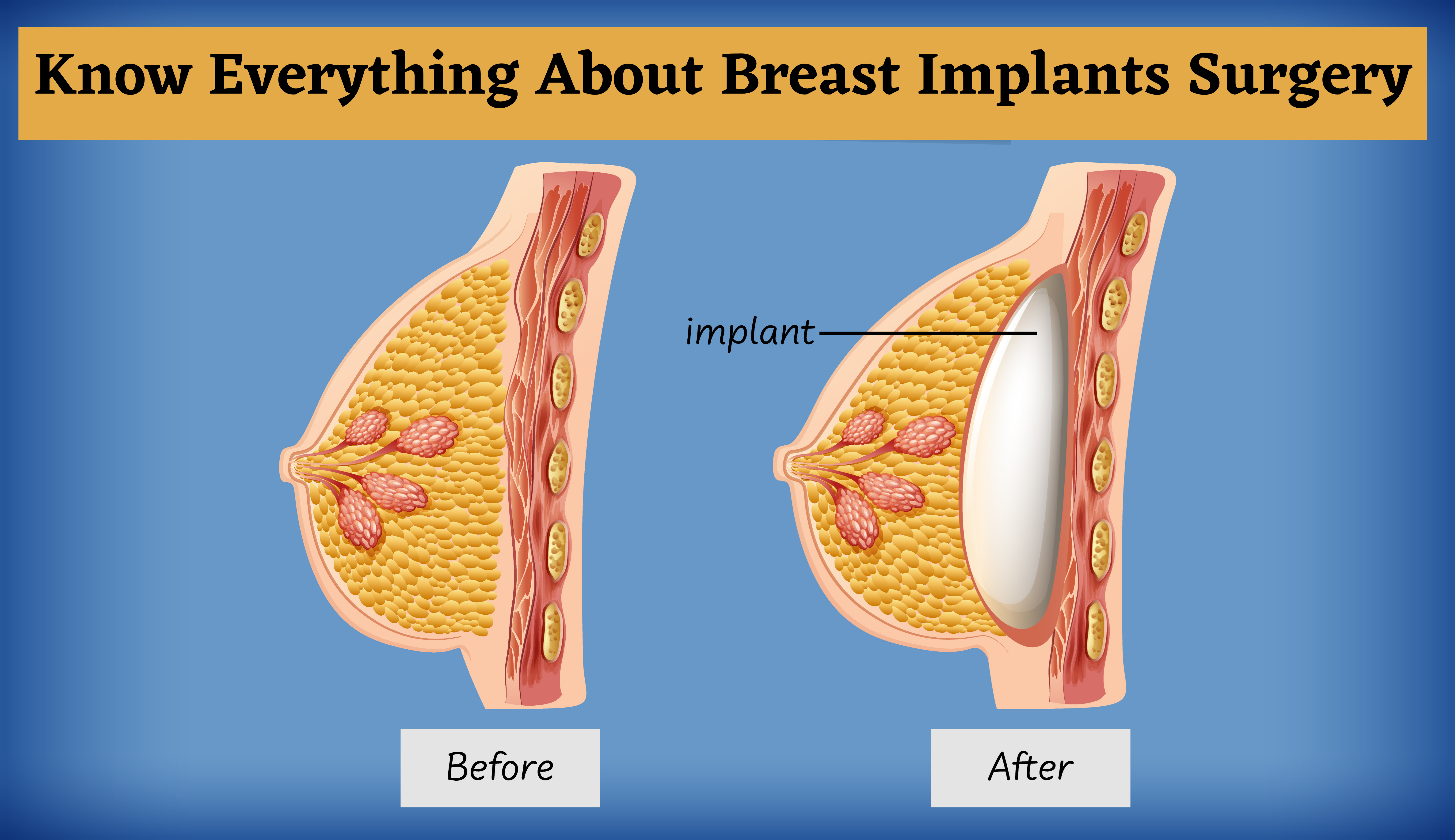 Breast Implants Surgery in Nashik
