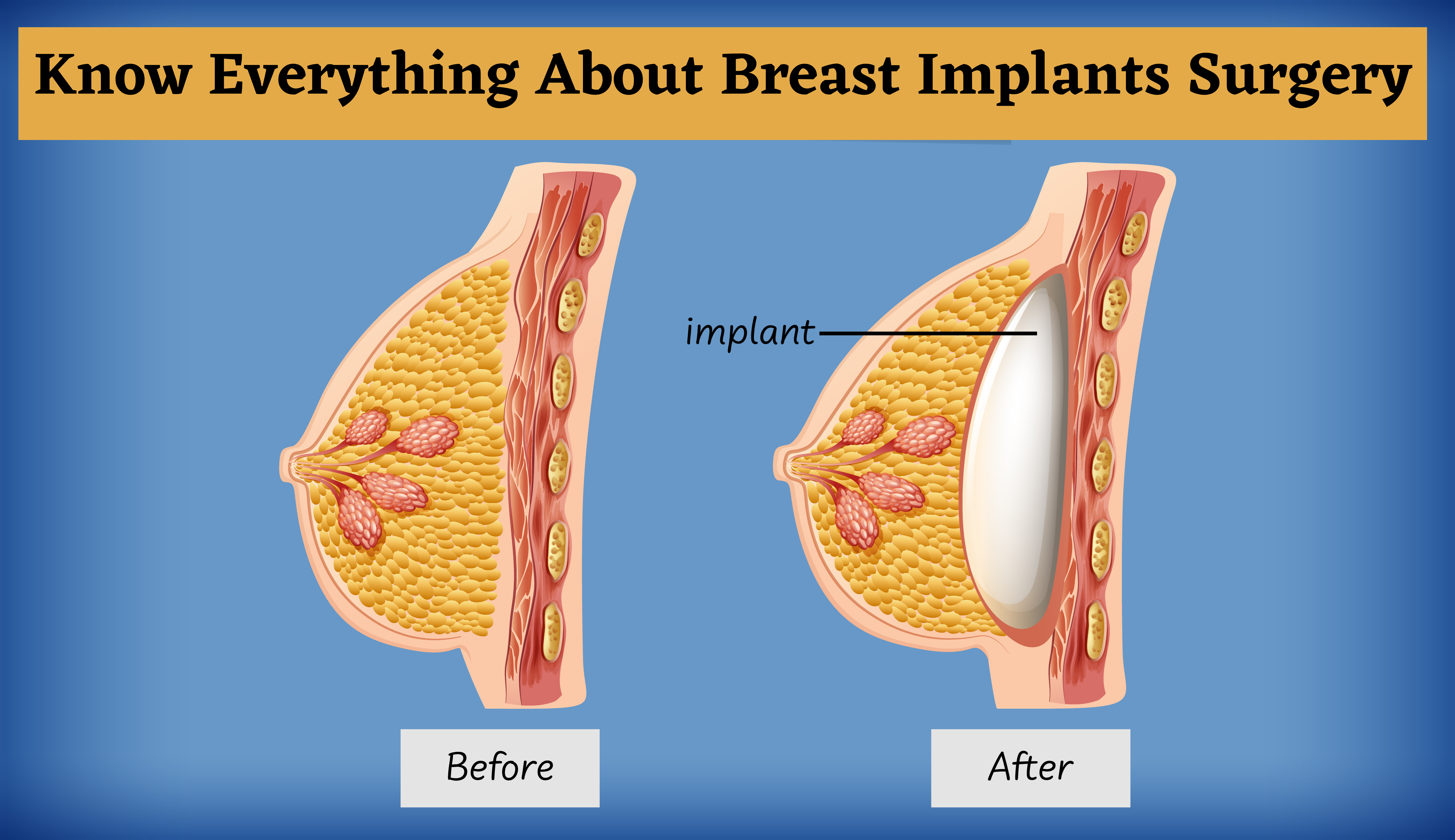 Update 10 things you should know before breast surgery And the