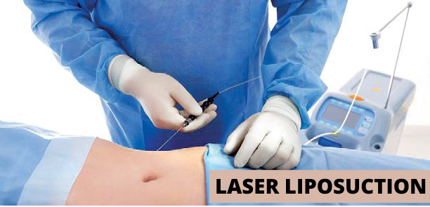 LASER LIPOSUCTION