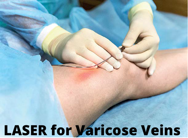 LASER for Varicose Veins