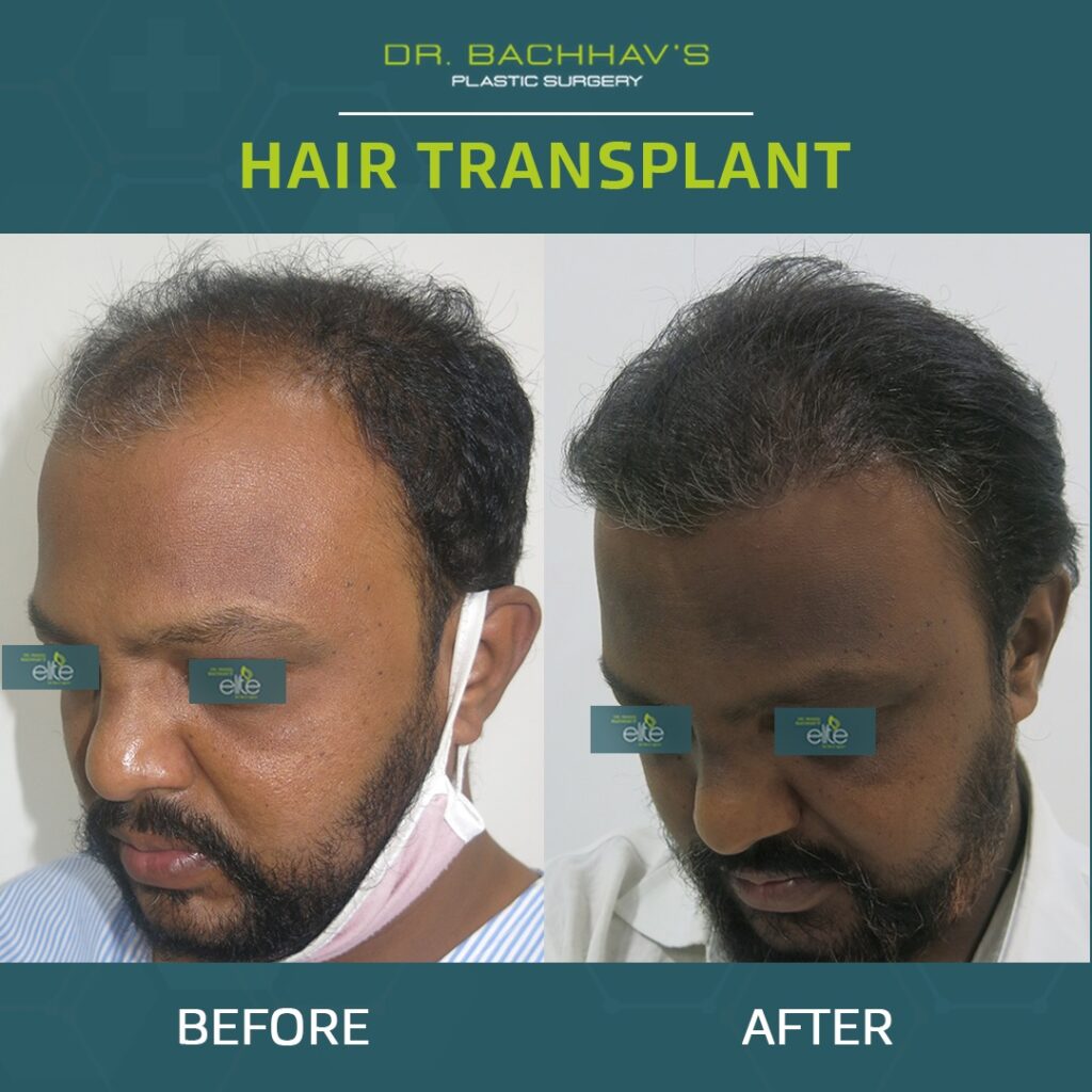 Before & After Part 1 - bachhavcosmeticsurgery